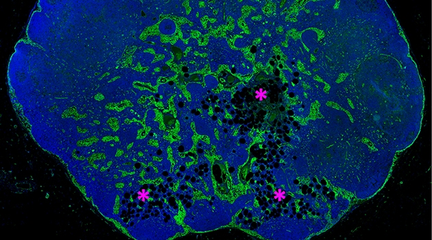 Lymph node (LN) with early stage lipomatosis (fat) in the medullary area of the LN. Adipocytes (fat cells shown as black, round cavities) are marked by asteriks' in magenta.