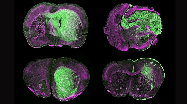 Hjärntumörer från fyra olika patienter som återskapats i möss. I bilden motsvarar grön färg tumörceller.