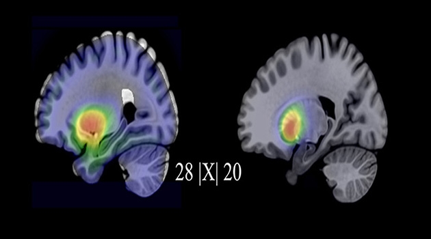 Till vänster serotonin- och till höger dopamintransportörbindning före behandling. Beskuren bild från en studie om att olika förändringar i hjärnan med SSRI och KBT.