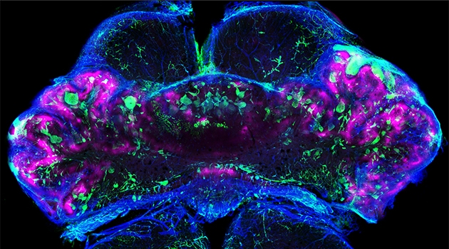En mushjärna med regioner i hjärnan som saknar syre (hypoxic, magenta) på grund av att blodkärlen (kollagen IV, blått) har blivit tilltäppta med levrat blod (fibrin, grönt). 