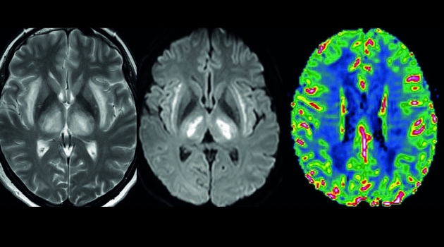 Bilderna illustrerar patologiska fynd på MR undersökning av hjärnan hos en patient som drabbats av covid19 med svåra neurologiska symtom.