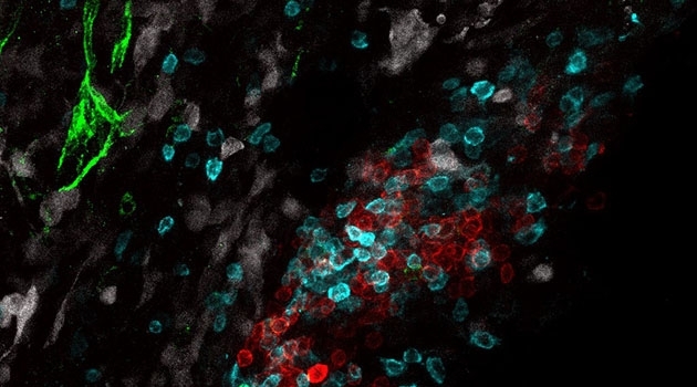 En tertiär lymfoid struktur vid en experimentell hjärntumör; Tumörcellerna är vita, B-cellerna är röda, T-cellerna är turkosa, ett blodkärl i tumören är grönt. 