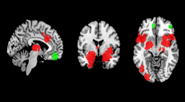 After a person with arachnophobia has seen a picture of a spider, the reaction in the brain is visible here. It shows that the activity in the amygdala increases. (Red shows increased activity.)