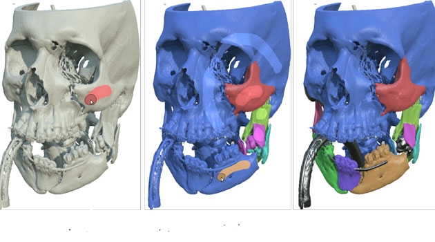 The new method allows surgeons to do a CT scan of the damaged jaw and then put together the broken jaw on a computer like a 3D puzzle before performing the actual operation.