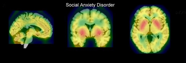 De röda fälten i hjärnan på bilden visar serotonin-syntesen hos en patient med social fobi. Signalämnena serotonin och dopamin är centrala för att studera blyghet och social fobi.