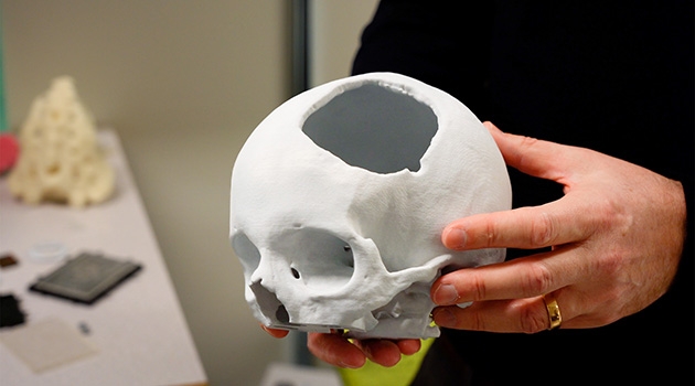 En kranium med en allvarlig skallskada skrevs ut med 3D-skrivare för att underlätta framtagandet av ett implantat.