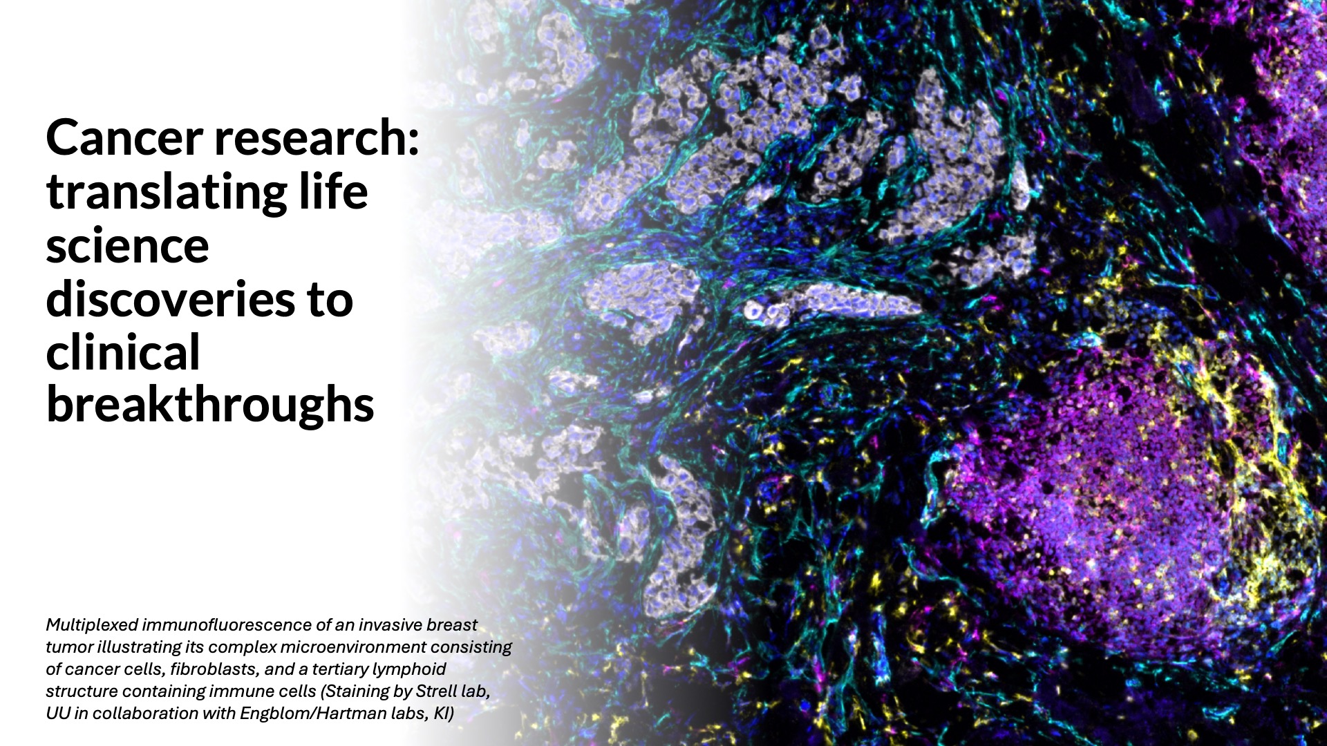 Multiplexed immunofluorescence of an invasive breast tumor illustrating its complex microenvironment consisting of cancer cells, fibroblasts, and a tertiary lymphoid structure containing immune cells (Staining by Strell lab, UU in collaboration with Engblom/Hartman labs, KI)