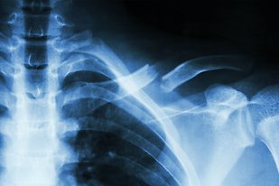 Röntgenbild av en axel som är bruten. 