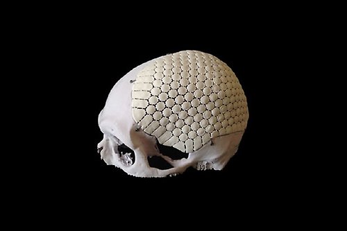 A cranium with the left half covered by bioceramics.