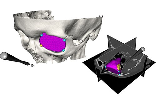 Tredimensionell illustration av kranium, även i genomskärning.
